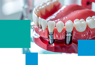 Implantes dentales en Málaga - Doctores Plaza - Clínica dental en Málaga Centro